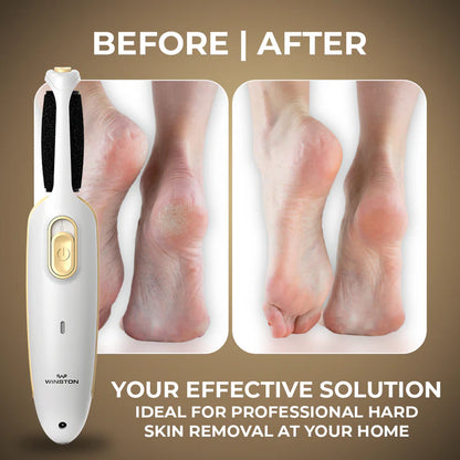 SKODS Callus Remover